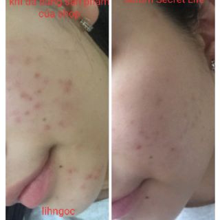 (💥CHÍNH HÃNG) Serum trị mụn Secret Life (hàng sẵn có).