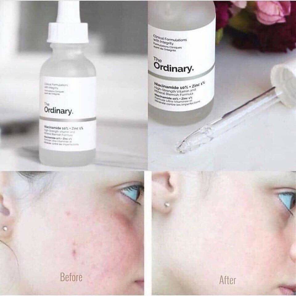 Serum Ordinary Niacinamide 10 Zinc 1 Chính Hãng Tinh Chất Niacinamide Ngừa Mụn Collagen Giảm Thâm Trắng Da Skincare Dezy
