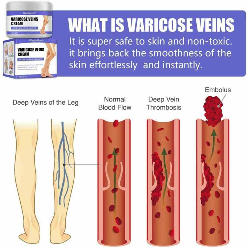 Vein Care Fading Cream Varicose Veins Cream for Legs Veins Herbal Ointment