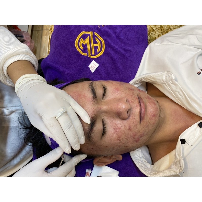 - Lấy nhân mụn chuyên sâu- Hoàng Wy Spa