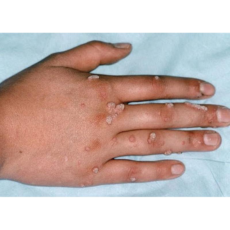 Dung dịch diệt mụn cơm, mụn cóc, sạn cá, mụn thịt của nga, sẵn hàng | BigBuy360 - bigbuy360.vn