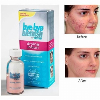 Dung dịch chấm mụn Bye Bye Blemish Drying Lotion 29.5ml