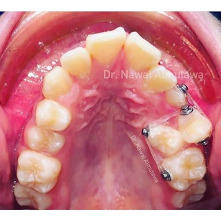 Button Chỉnh Nha, Cánh Tròn Núm Sử Dụng Trong Chỉnh Nha Chuyên Nghiệp