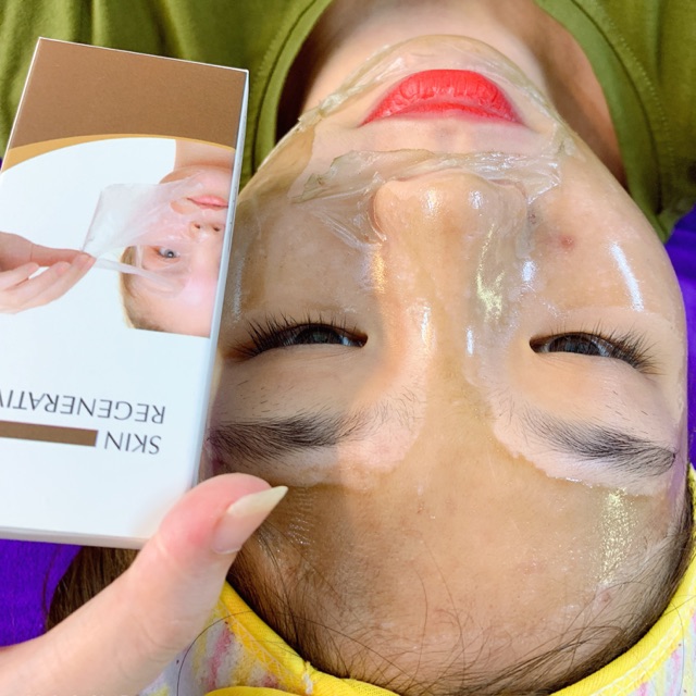 NẠ MÀNG HÚT CHÌ MỜ THÂM NÁM
