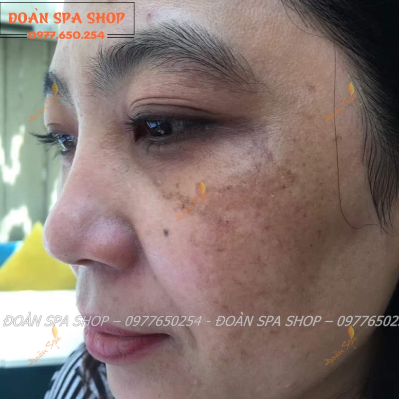 Bộ Phân Hủy Nám Deva Cell - Devacell Luxury