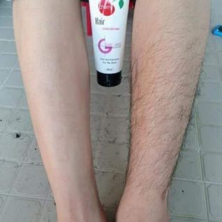 Triệt lông Mwhite