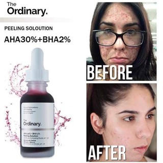 Tẩy da chết hoá học The Ordinary AHA 30%+ BHA 2% Peeling Solution
