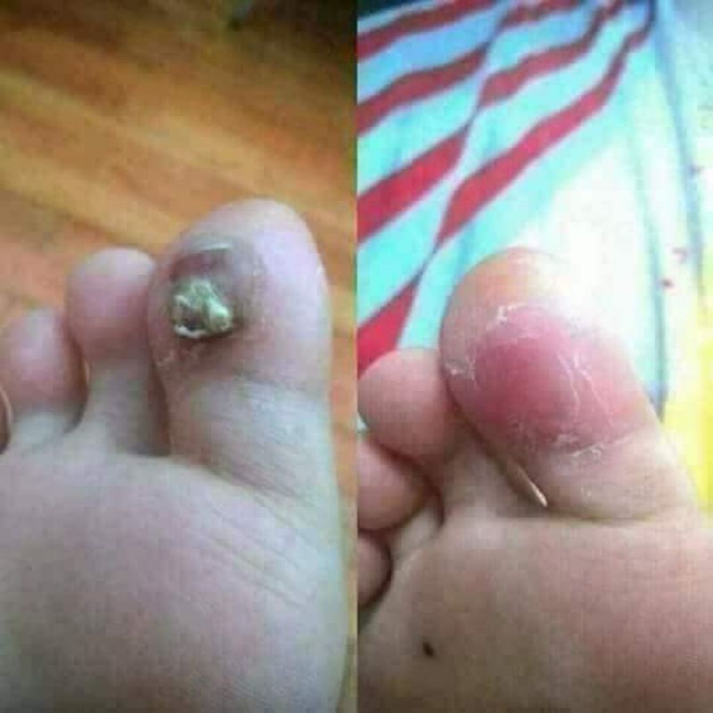 Gel tẩy mụn cóc nốt ruồi Nga chính hãng