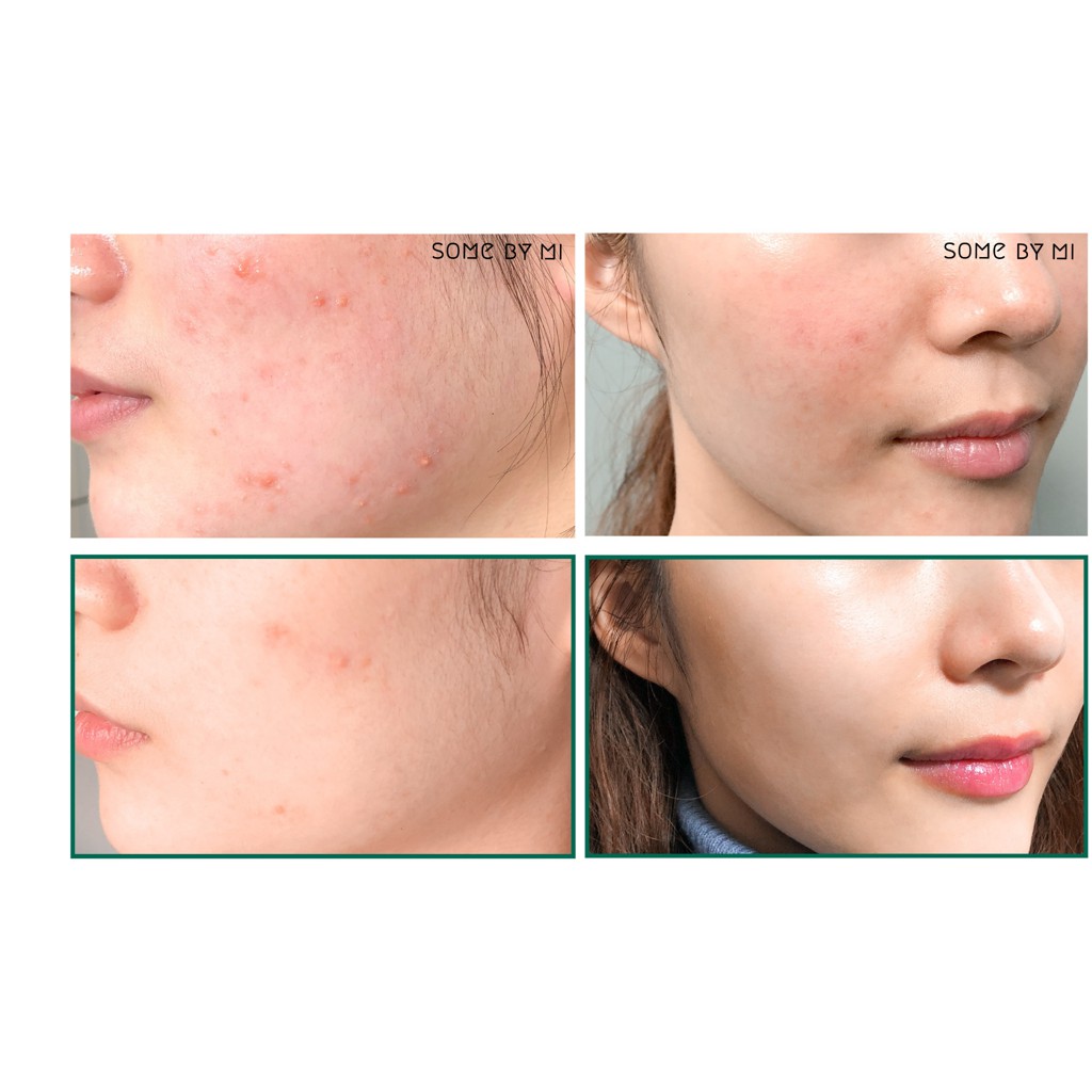 Sữa rửa mặt Some By Mi AHA-BHA-PHA 30 days Miracle Acne Clear Foam | BigBuy360 - bigbuy360.vn