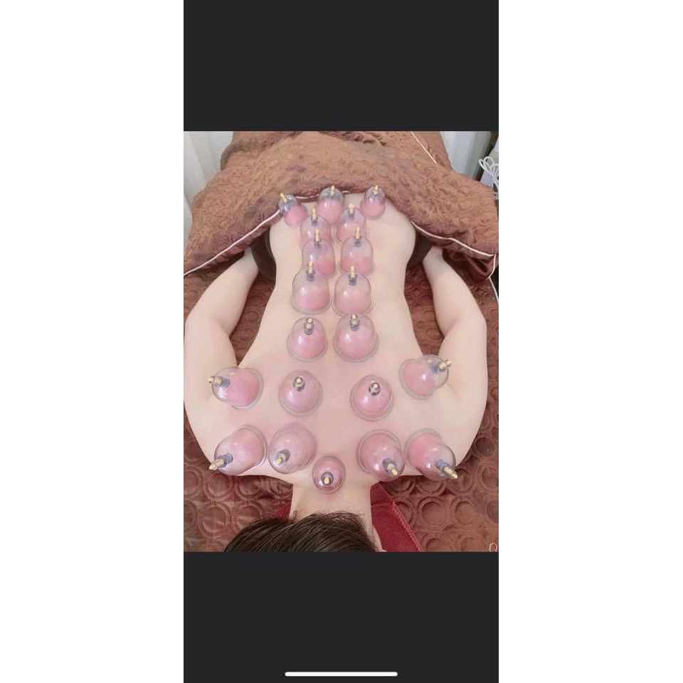 Bộ Cốc Giác Hơi Không Dùng Lửa 24 Cốc, Dụng Cụ Cạo Gió Giác Hơi Chân Không 24 Cốc