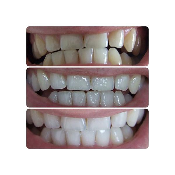 Combo 2 gói dán răng Crest 3D Whitestrips 1 Hour Express (1 gói gồm 1 miếng hàm trên+ 1 miếng hàm dưới)