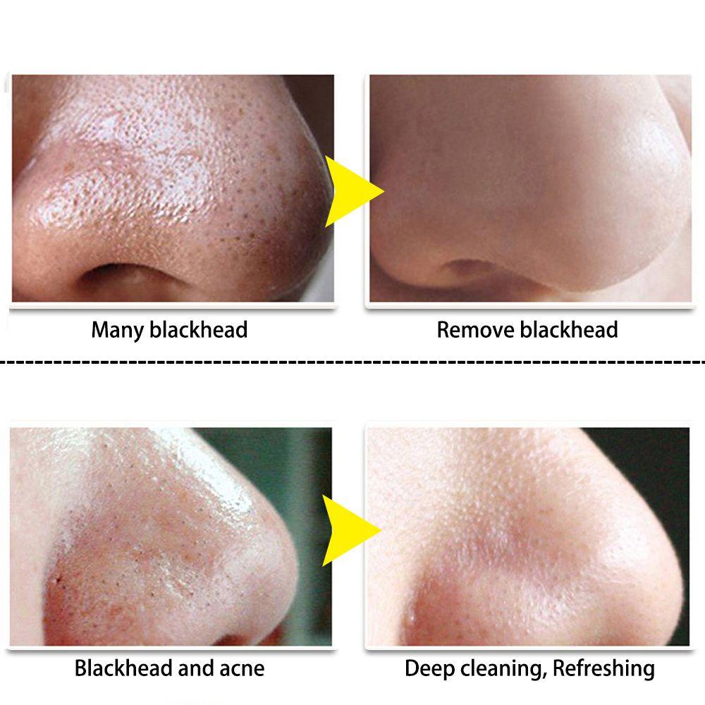 Mặt Nạ Lột Mụn Đầu Đen Cho Mũi Làm Sạch Sâu Lỗ Chân Lông