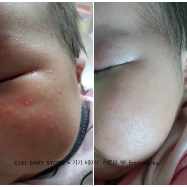[ Chính Hãng] KEM DƯỠNG MẶT DA KHÔ NẺ CHÀM ATOPALM FACE CREAM TRẺ SƠ SINH,TRẺ EM,NGƯỜI LỚN &lt;35ml&gt;