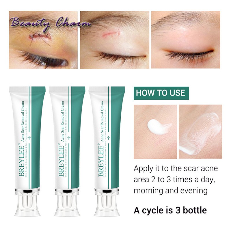 [Hàng mới về] Kem Hỗ Trợ Giảm sẹo 30ml chuyên dụng | BigBuy360 - bigbuy360.vn