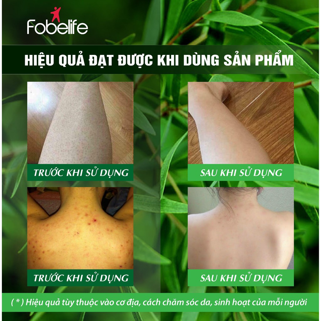 Sữa Tắm Giảm Mụn Lưng, Bệnh Nang Lông ACNEVIR chai 210ml