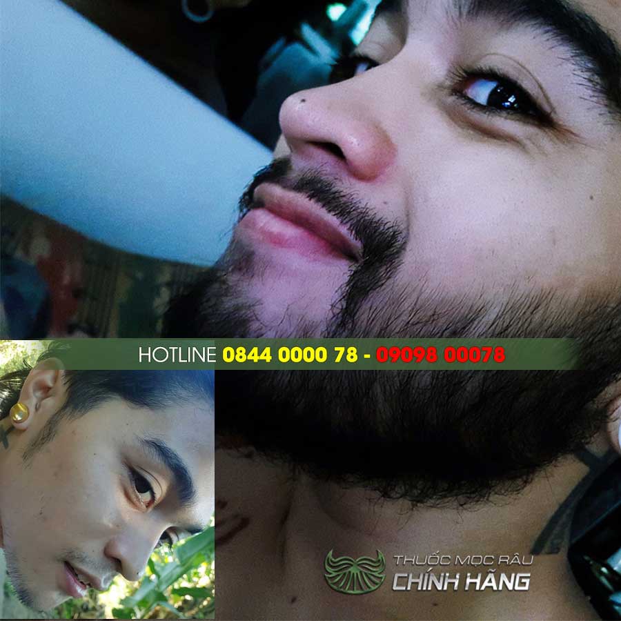 Dung dịch mọc râu Morr 12,5% Minoxidil 12,5% Intas