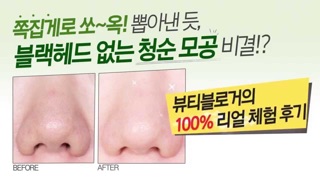 THANH LĂN MỤN MAMONDE