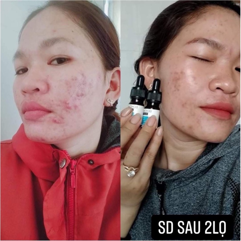 Serum mụn Thảo dược Behome Spa  👉FREESHIP👉 Serum mụn thảo Dược Behome Spa, Mụn ẩn, mụn thâm, mụn cám, mụn viêm | BigBuy360 - bigbuy360.vn