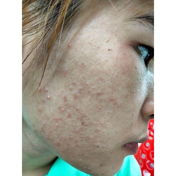 Cốt sâm Spa chuyên mụn , thâm , nám , se khít lỗ chân lông , trắng da handmade