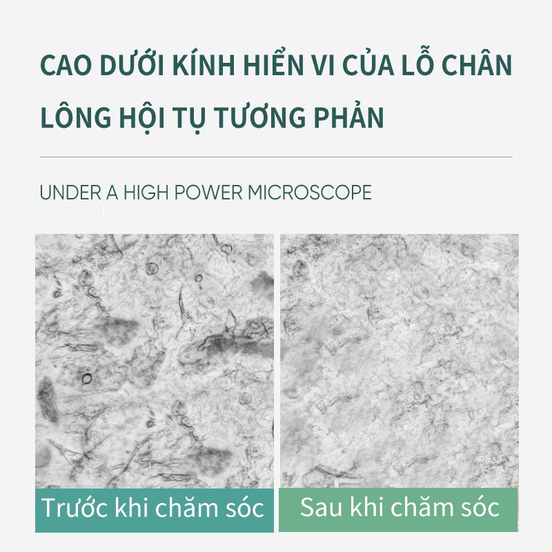 Bộ Tinh Chất Chăm Sóc Cải Thiện Mụn Đầu Đen Soon Pure Se Khít Lỗ Chân Lông 22g