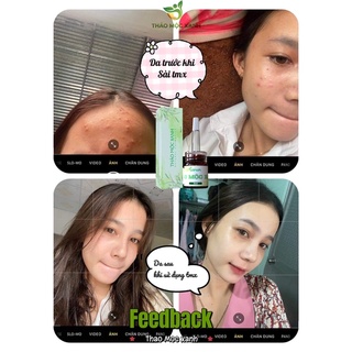 Serum thảo mộc xanh x5 (𝐅𝐫𝐞𝐞𝐬𝐡𝐢𝐩) tặng tắm trắng 50ml