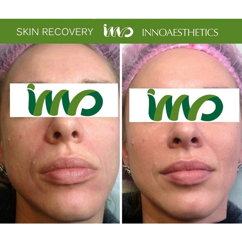 Peel tái tạo, giảm mụn INNOAESTHETICS Skin Recovery 5 lọ x 5ml