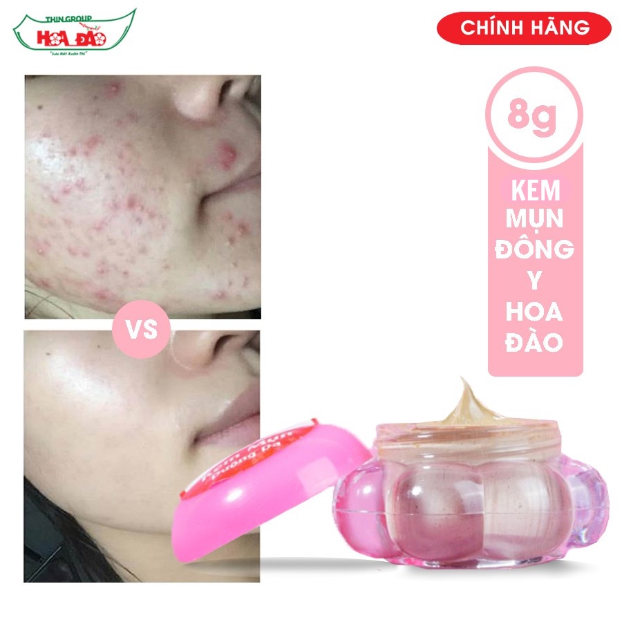 Kem mụn Hoa Đào 8g – Dưỡng da hiệu quả sau 2 tuần