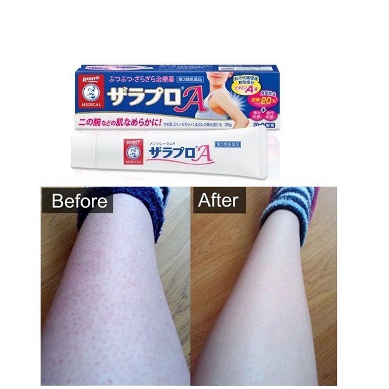 [Auth] Kem viêm nang lông Zaraporo Rohto 35g Nhật Bản date 2024/2025