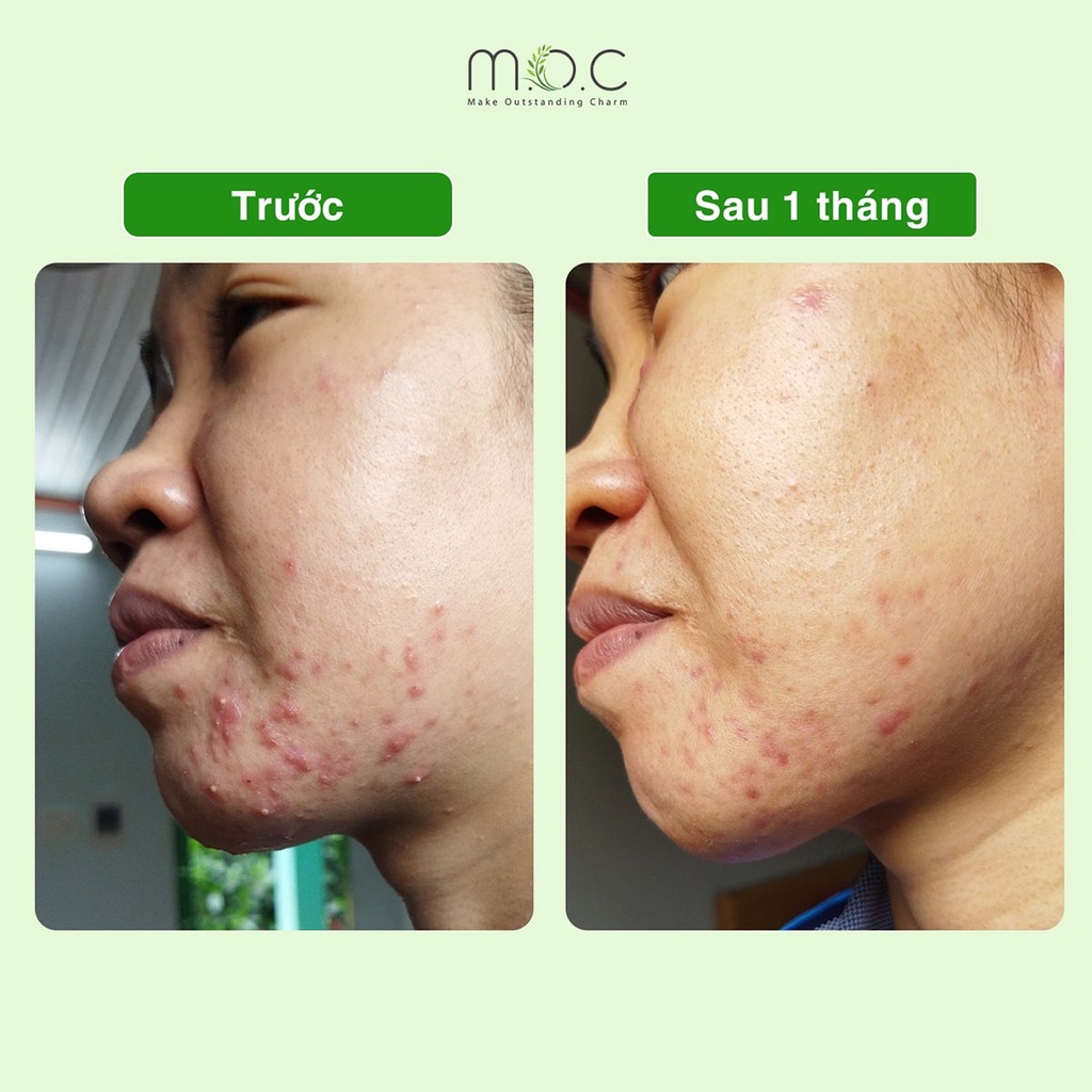 Tinh Dầu Tràm Trà Chấm Mụn Viêm M.O.C hiệu quả sau 48h