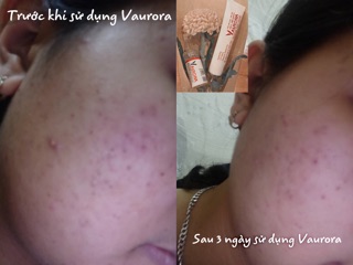 Combo Dược Mĩ Phẩm Vaurora