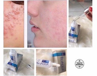 SERUM dưỡng da mụn BIOAQUA 30ml