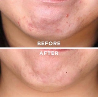 Serum the ordinary zinc 1%