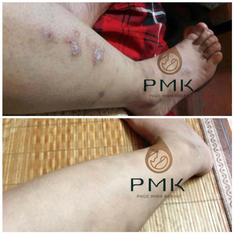 Tinh chất Xóa thâm Minh Khang Xoá mờ thâm sẹo thâm mắt, thâm môi, thâm nách, thâm mụn, thâm sẹo lâu năm