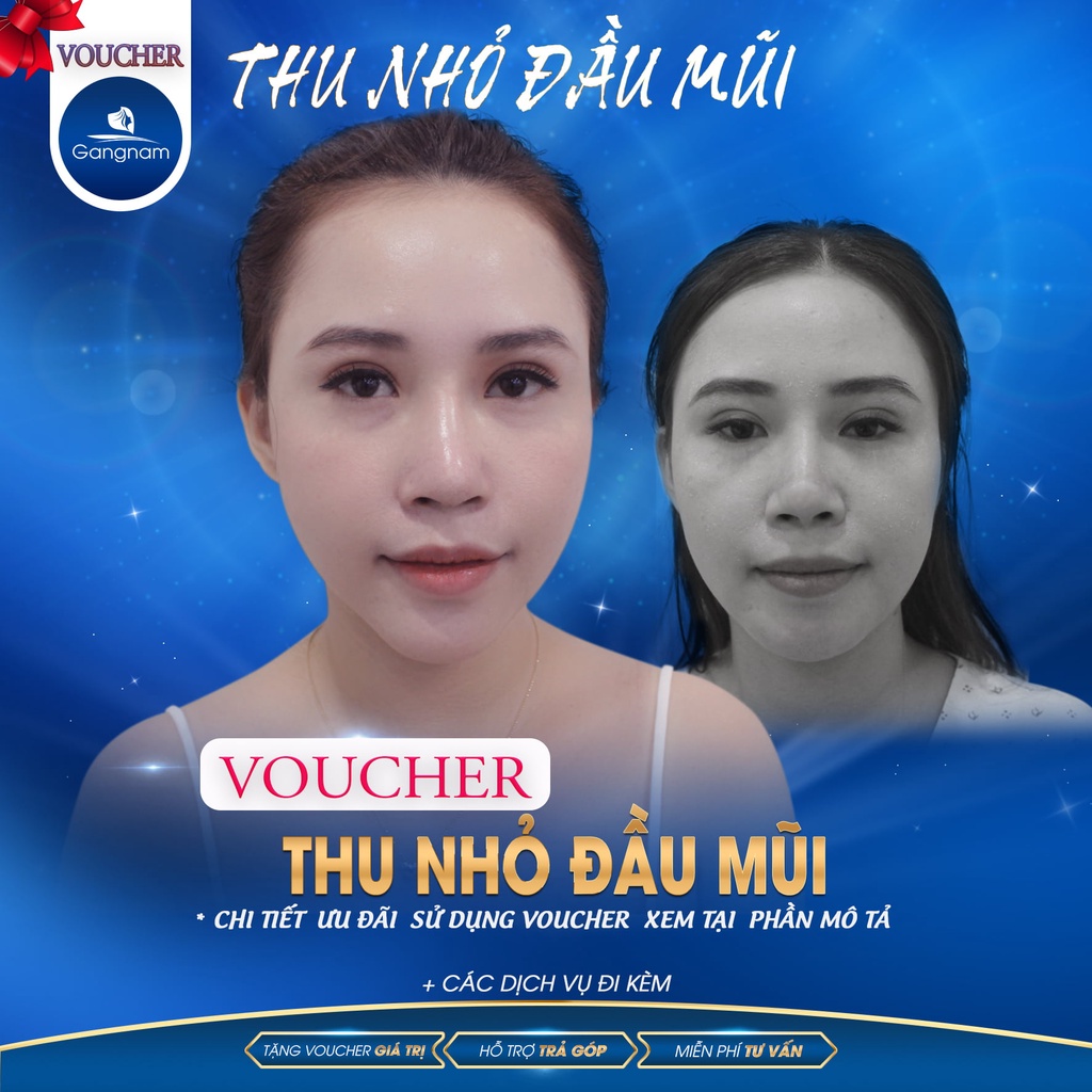 Chỉnh Xương Mũi Thô | Thẩm Mỹ Viện Gangnam
