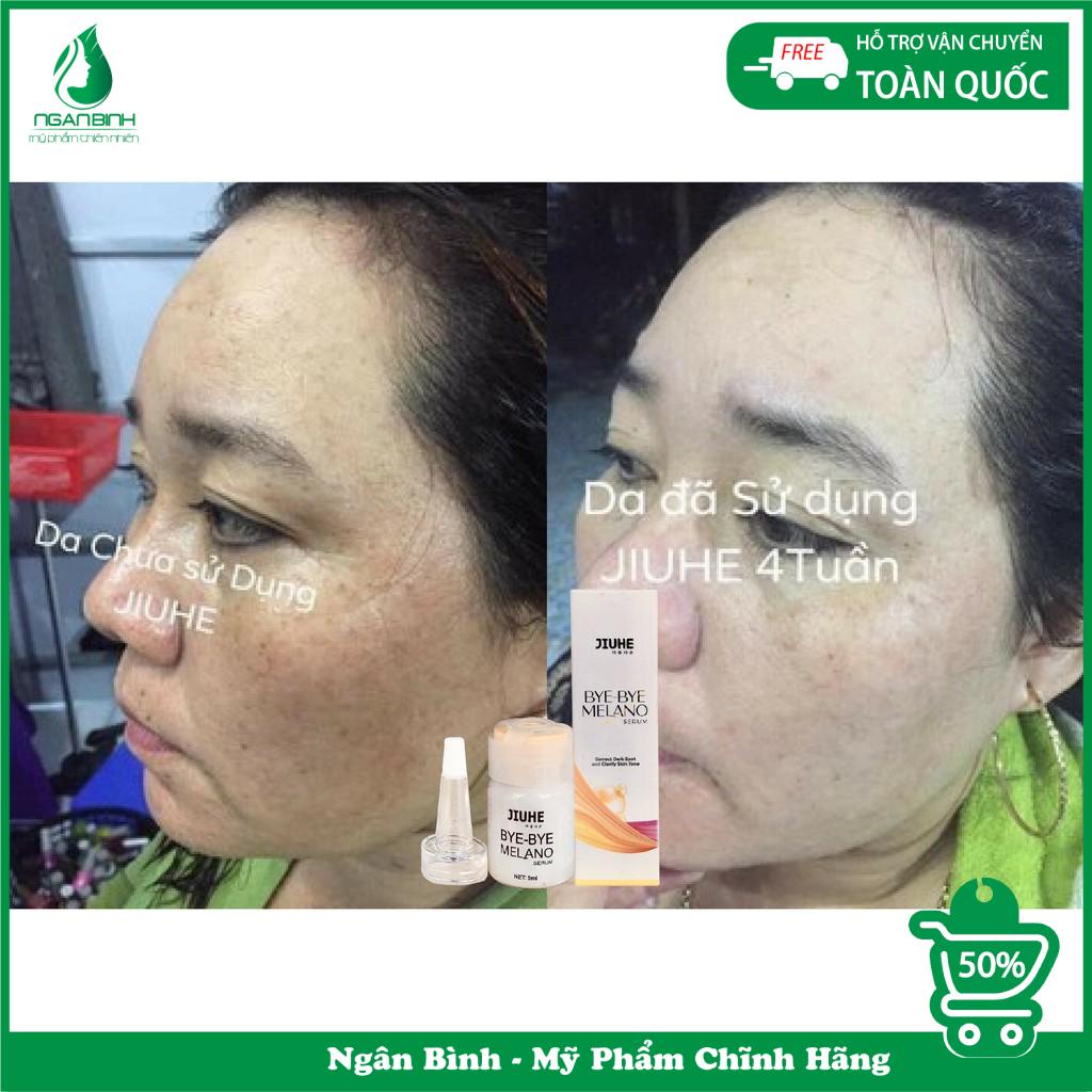 Serum thâm jiuhe, thâm mụn cho da dầu,tinh chất  thâm nám ,thâm môi,thâm mắt,thâm vùng kín,