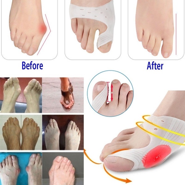 2 dụng cụ tách ngón chân giảm đau hiệu quả tiện lợi