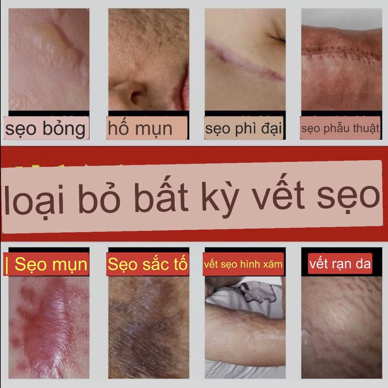 kem thoa sẹo : vết bỏng sẹo bỏng và vết sẹo sau khi  phẫu thuật , sẹo mổ đẻ, sẹo mụn nhọt, vết sẹo hình săm , sẹo rạn da