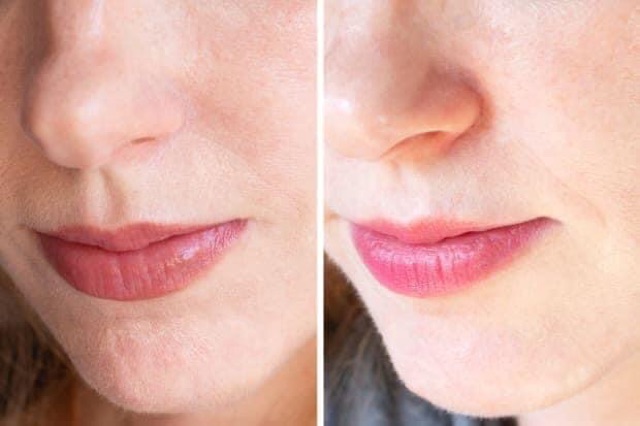 Kem A313 retinol chính hãng có BILL mua tại Pháp