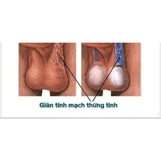 Tinh chất hàu, bổ thận âm, giãn tĩnh mạch tinh, tinh trùng yếu loãng ít
