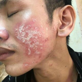 BONG NÁM +CHÂN RỖ PHƯƠNG ANH