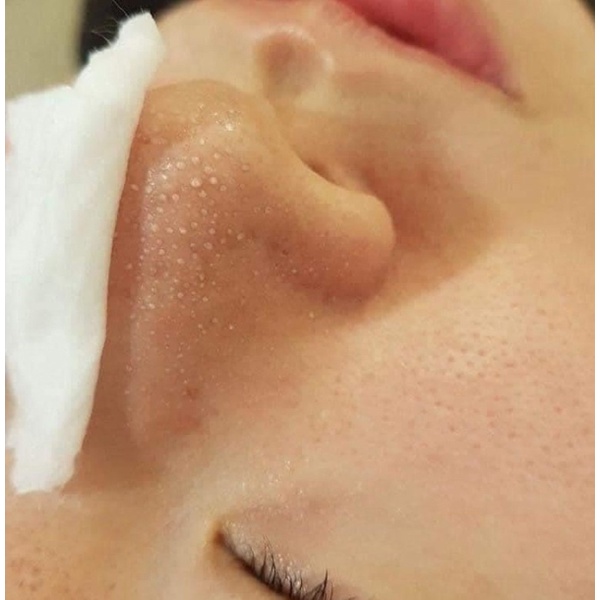 Ủ mụn đầu đen Removes BlackHeads 50ml