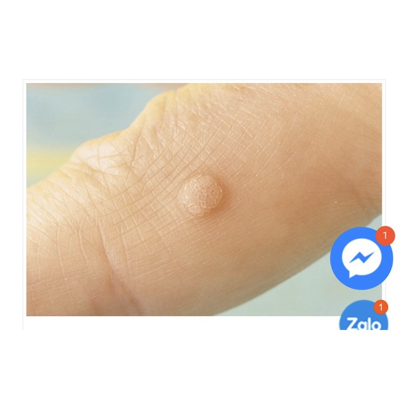 Miếng dán trị mục cóc, mụn cơm, vết chai | BigBuy360 - bigbuy360.vn