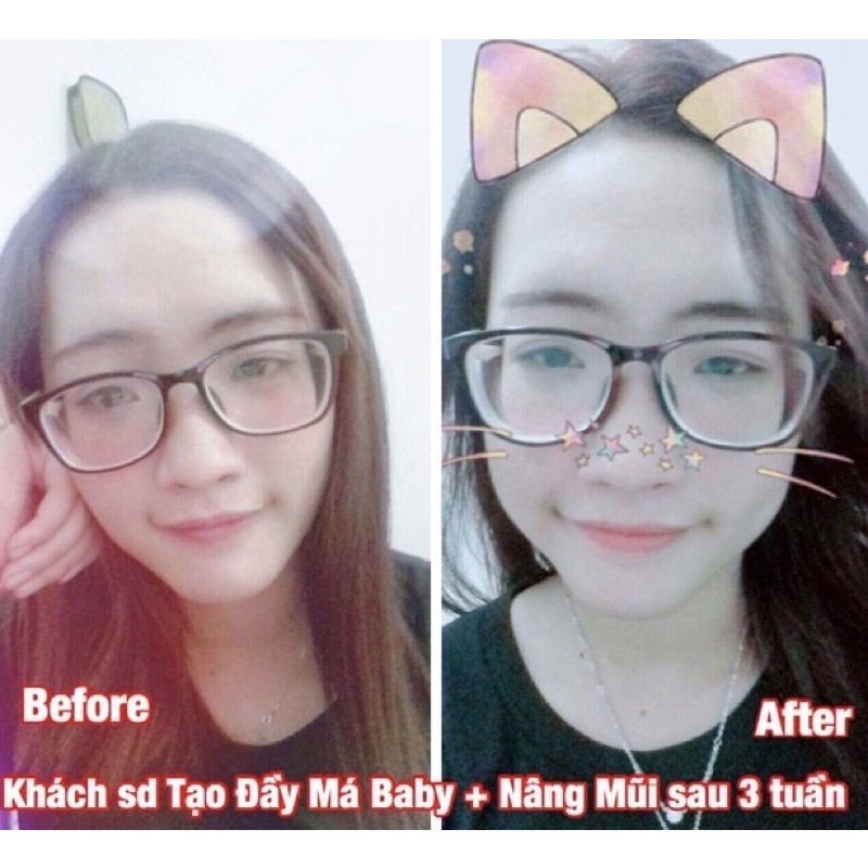 Tinh chất Mircale Pháp làm đầy má, tạo má baby chỉ sau 1 tháng