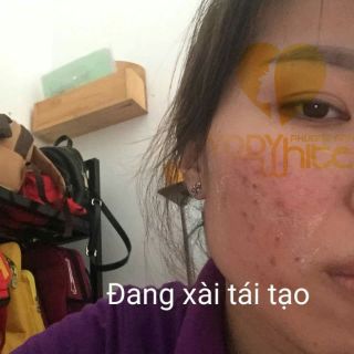 CHẤM TÀN NHANG, SẸO RỖ, MỤN RUỒI, MỤN THỊT