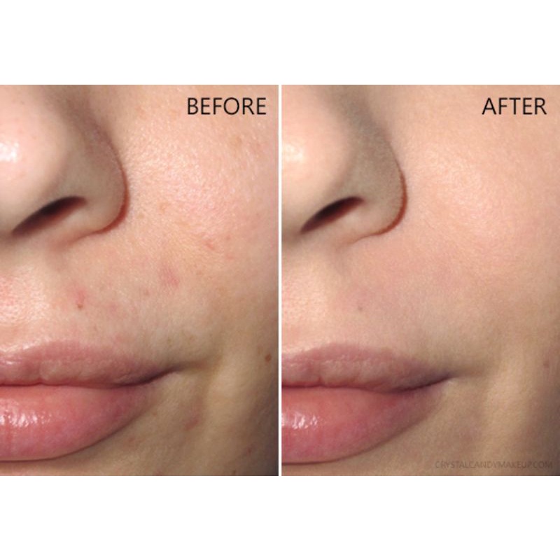 Benozyl Tretinon 10ml