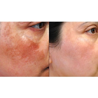 [ỐNG LẺ] Tinh chất sáng da mờ thâm Dsp Pigment Zero Mảtiderm