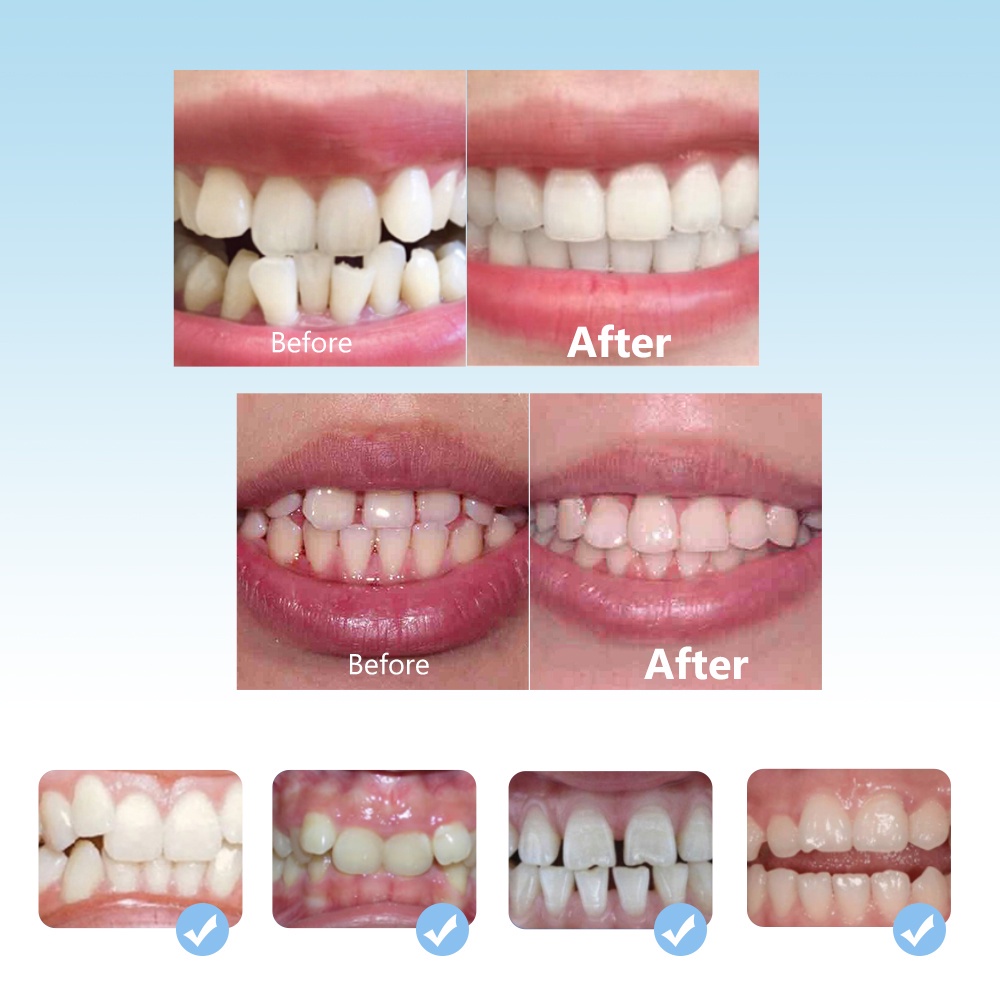 Set 3 dụng cụ niềng răng HailiCare ba bước 4D silicone an toàn dành cho người lớn