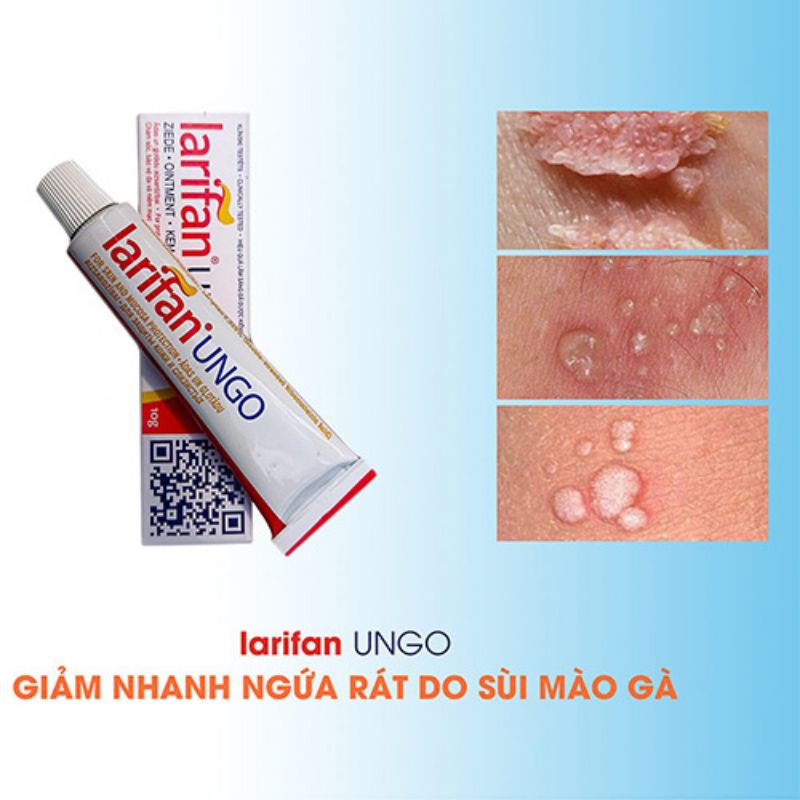 Loại bỏ mụn cóc sinh dục, sùi mào gà bằng kem bôi larifan ungo 1g.c( cam kết che sản phẩm khi giao).