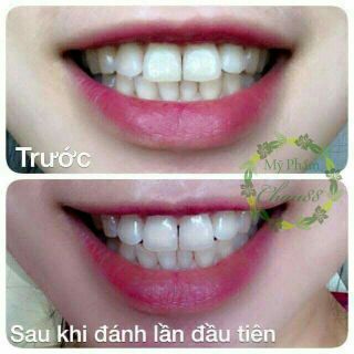 Bột tẩy trắng răng