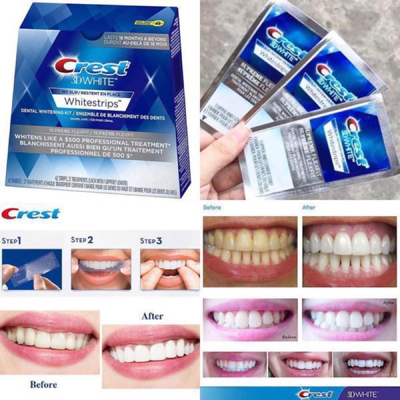 Miếng dán Crest 3D White strips làm trắng răng hiệu quả, an toàn